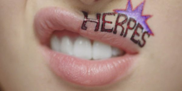 Herpes Labiale